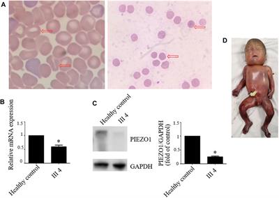 A Novel Homozygous Missense Mutation of PIEZO1 Leading to Lymphatic Malformation-6 Identified in a Family With Three Adverse Pregnancy Outcomes due to Nonimmune Fetal Hydrops